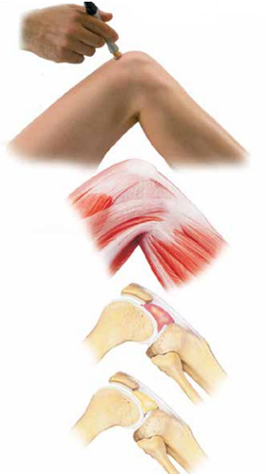 روش درمانی هیلتراپیا با لیزر هیرو 3 2 لیزر هیرو هیلتراپیا