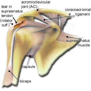 پارگی عضلات شانه(پارگی ماکروسکوپیک) 1 000212