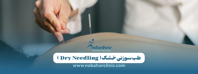 طب سوزنی چیست؟ کاربرد، مزایا، عوارض و روش انجام 4 طب سوزنی خشک