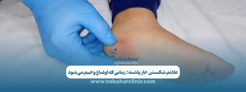 علائم خار پاشنه: از کودکان تا بزرگسالان 4 علائم شکستن خار پاشنه زمانی که اوضاع وخیم می_شود